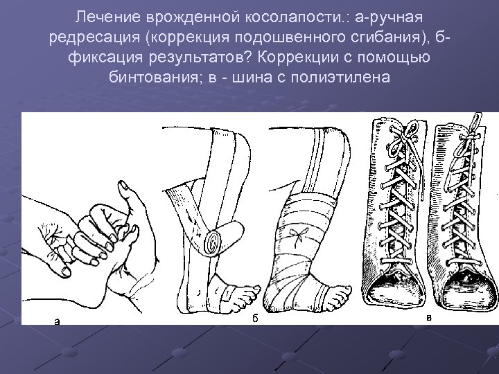 Лечение врожденной косолапости. : а-ручная редресация (коррекция подошвенного сгибания), бфиксация результатов? Коррекции с помощью