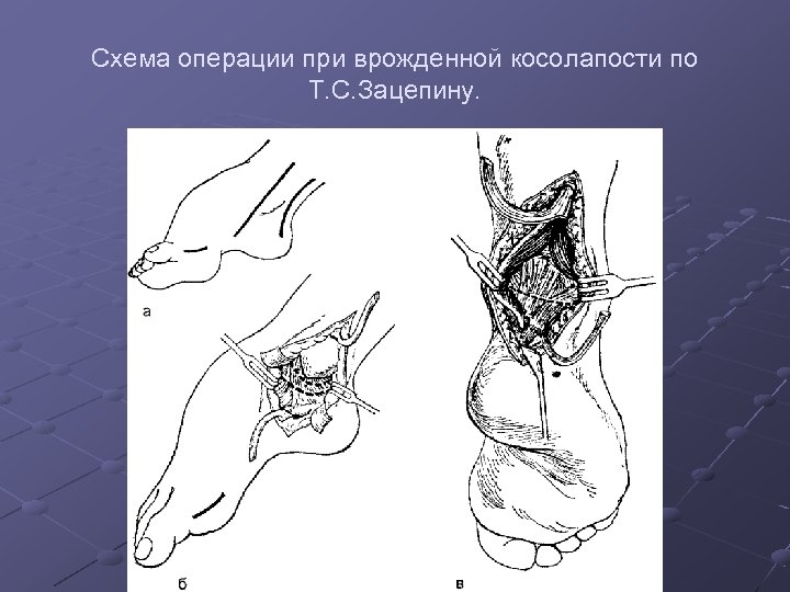 Схема операции при врожденной косолапости по Т. С. Зацепину. 