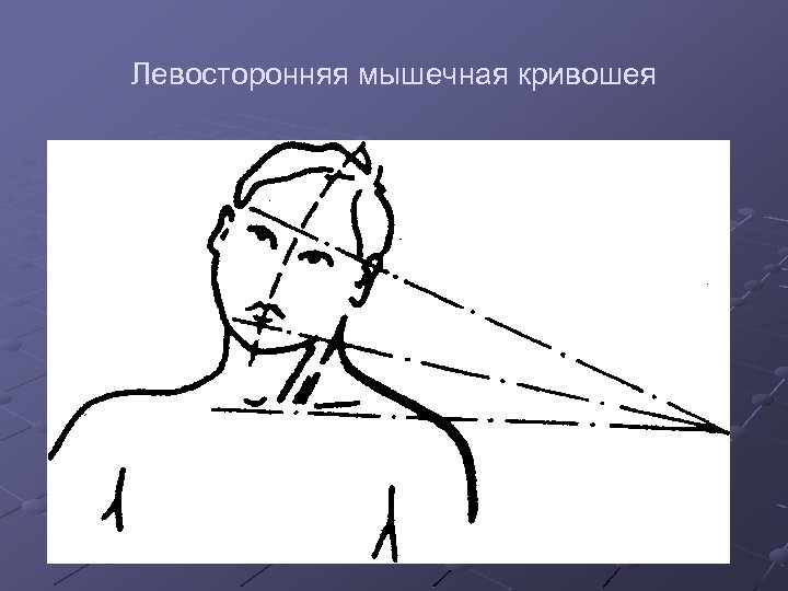 Левосторонняя мышечная кривошея 