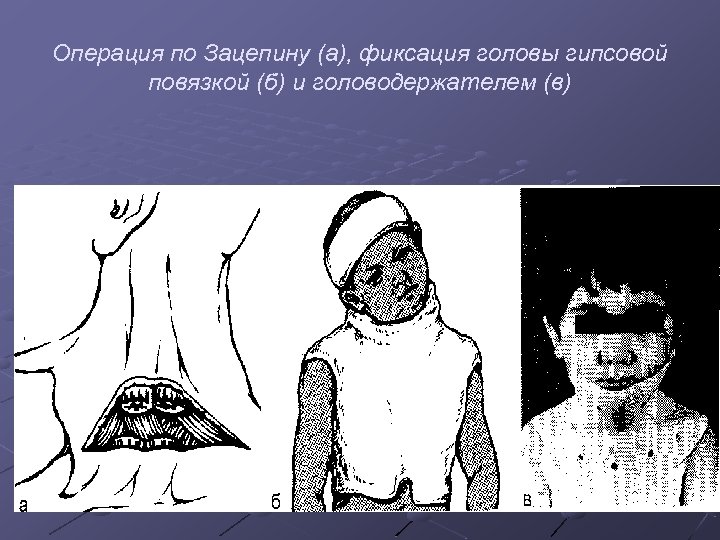 Операция по Зацепину (а), фиксация головы гипсовой повязкой (б) и головодержателем (в) 