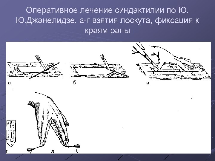 Оперативное лечение синдактилии по Ю. Ю. Джанелидзе. а-г взятия лоскута, фиксация к краям раны