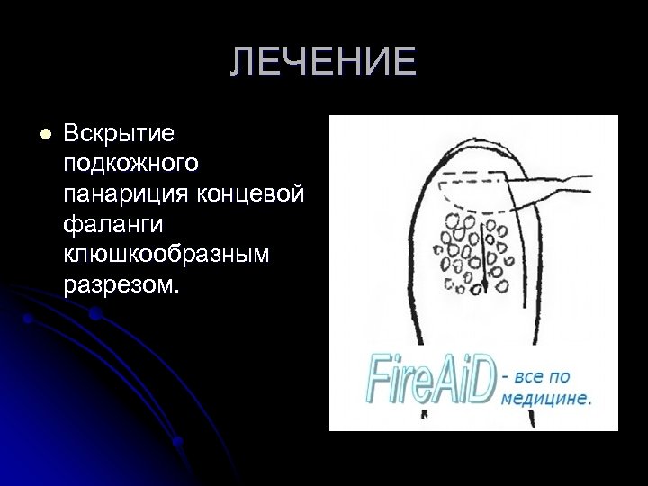 ЛЕЧЕНИЕ l Вскрытие подкожного панариция концевой фаланги клюшкообразным разрезом. 