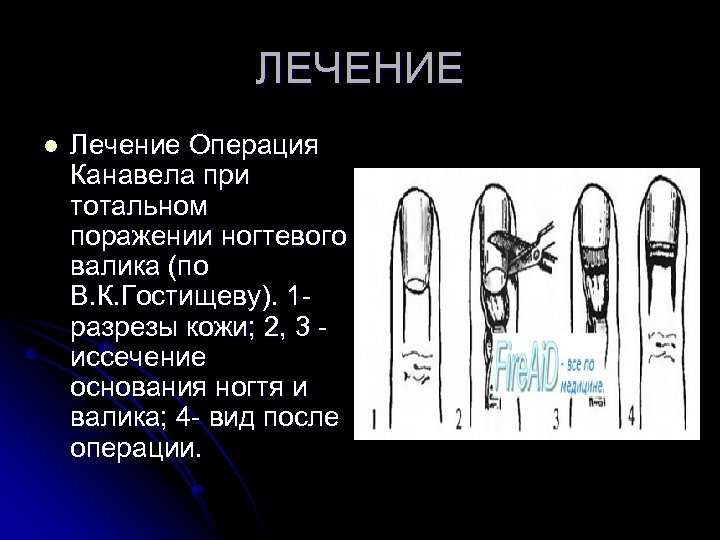 ЛЕЧЕНИЕ l Лечение Операция Канавела при тотальном поражении ногтевого валика (по В. К. Гостищеву).