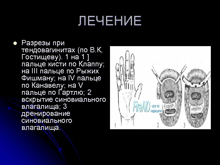 ЛЕЧЕНИЕ l Разрезы при тендовагинитах (по В. К, Гостищеву). 1 на 1 ] пальце