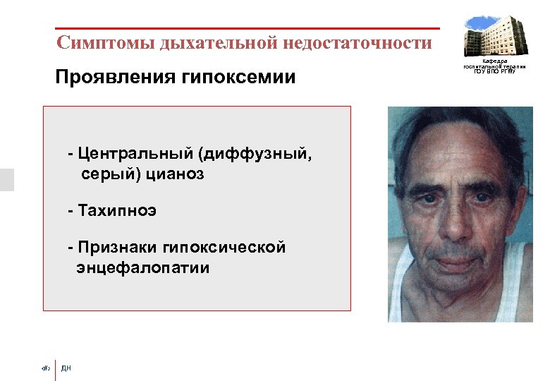 Симптомы дыхательной недостаточности Проявления гипоксемии - Центральный (диффузный, серый) цианоз - Тахипноэ - Признаки