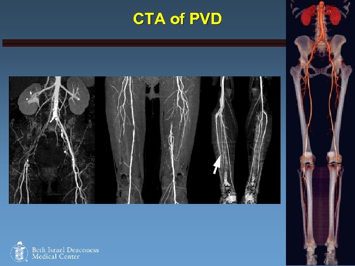 CTA of PVD Harvard Medical School 