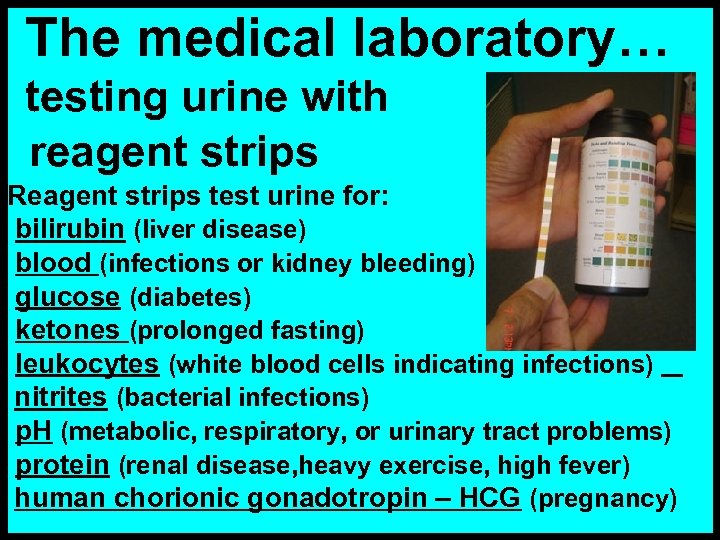 The medical laboratory… testing urine with reagent strips Reagent strips test urine for: bilirubin