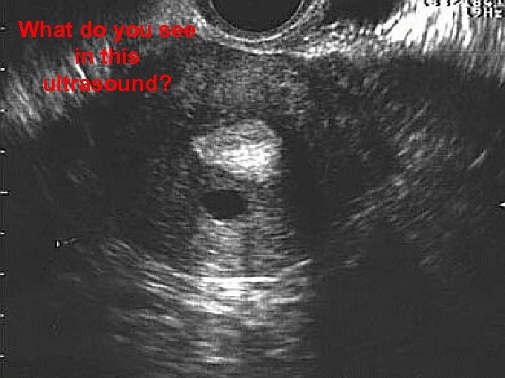 What do you see in this ultrasound? 