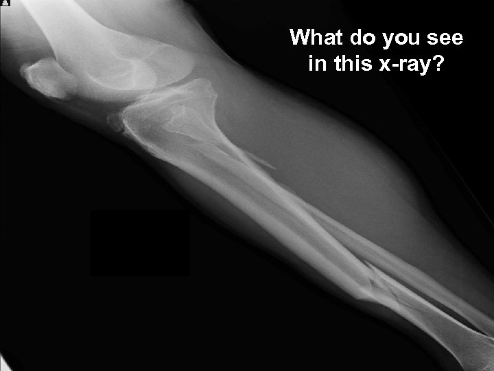 What do you see in this x-ray? 