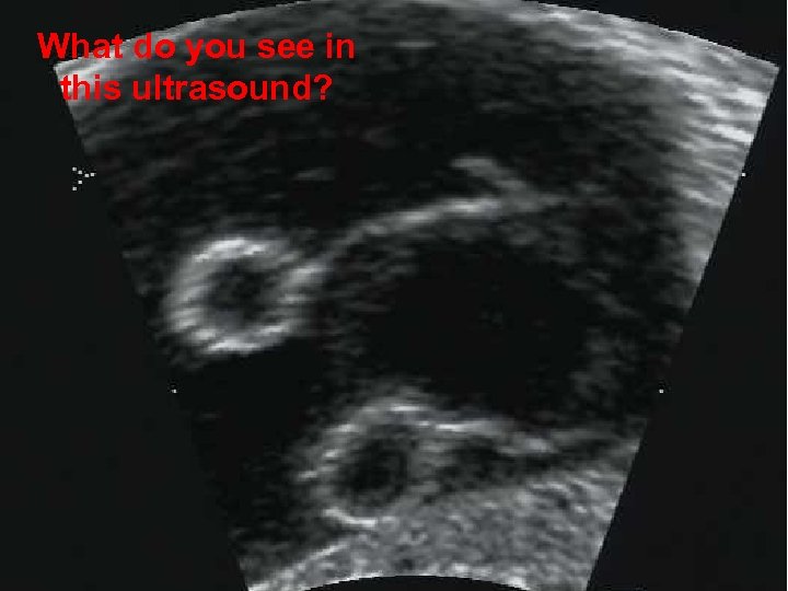 What do you see in this ultrasound? 