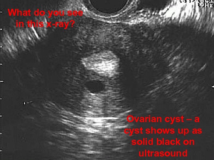 What do you see in this x-ray? Ovarian cyst – a cyst shows up