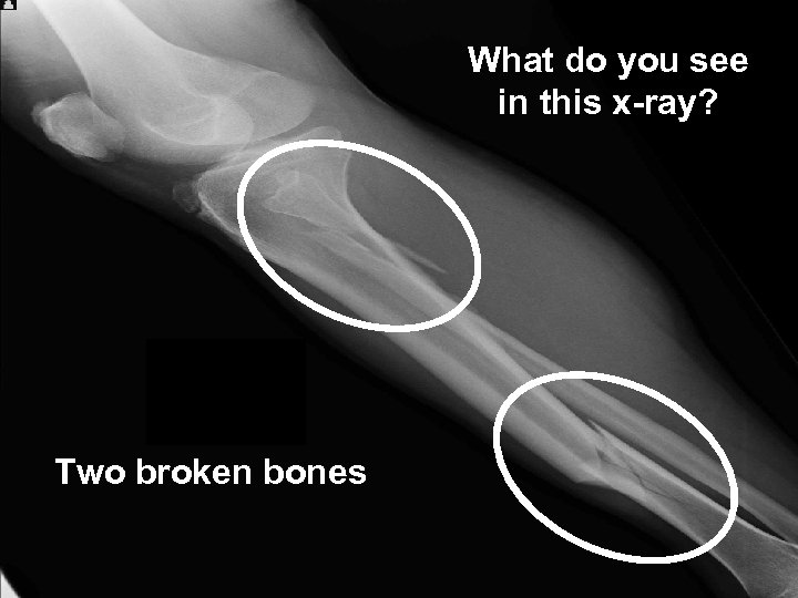 What do you see in this x-ray? Two broken bones 