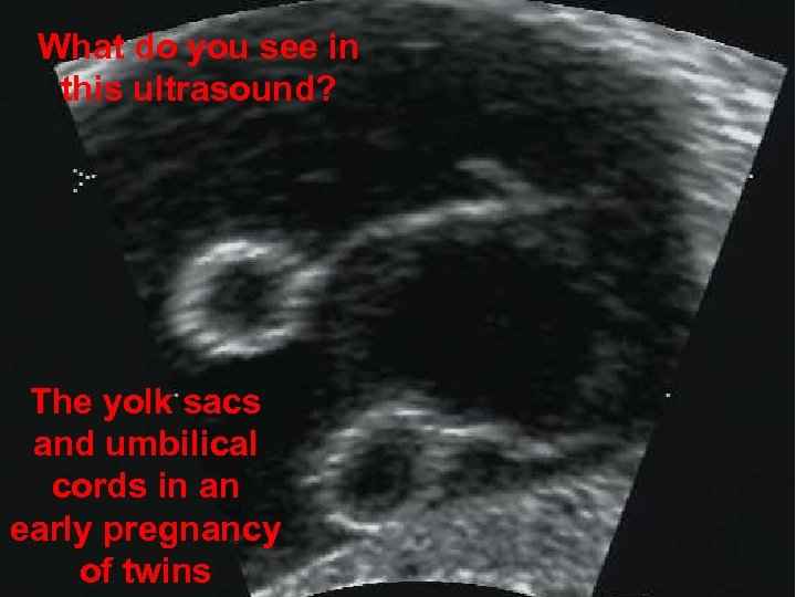 What do you see in this ultrasound? The yolk sacs and umbilical cords in