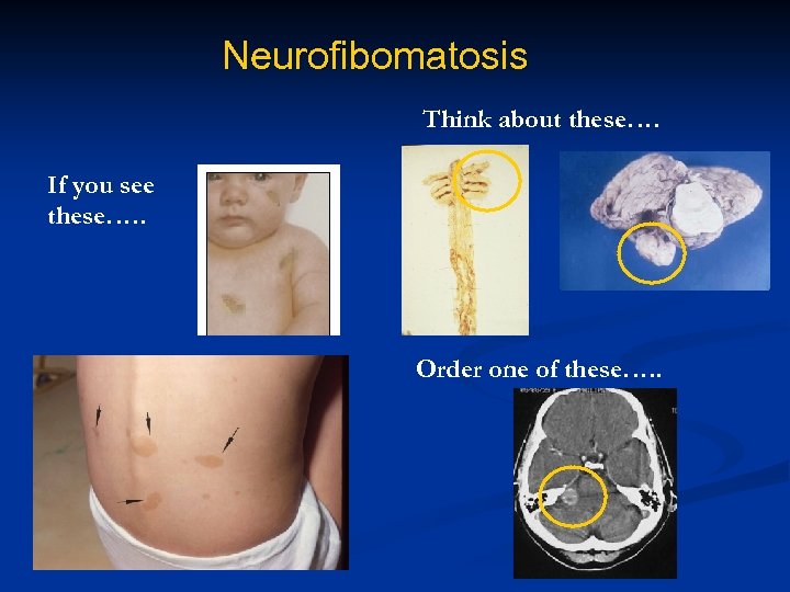 Neurofibomatosis Think about these…. If you see these…. . Order one of these…. .