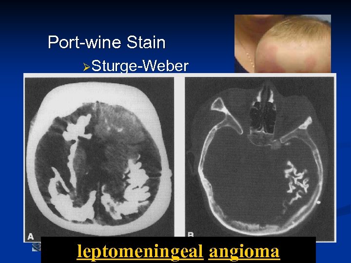 Port-wine Stain ØSturge-Weber leptomeningeal angioma 