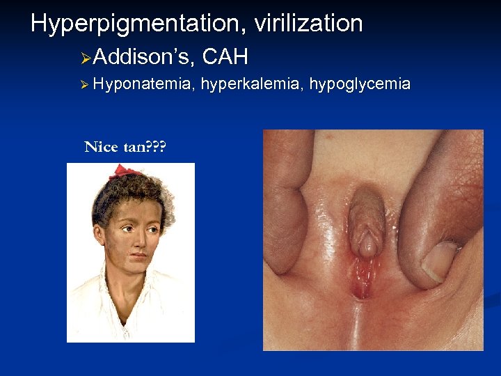 Hyperpigmentation, virilization ØAddison’s, CAH Ø Hyponatemia, hyperkalemia, hypoglycemia Nice tan? ? ? What the