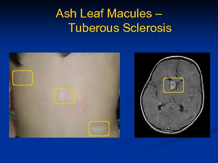 Ash Leaf Macules – Tuberous Sclerosis 