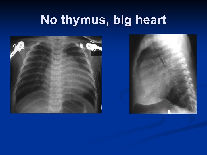 No thymus, big heart 