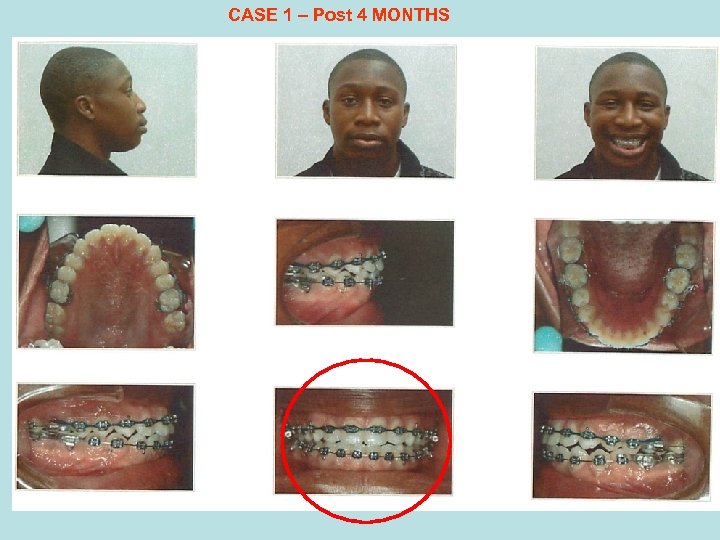 CASE 1 – Post 4 MONTHS 