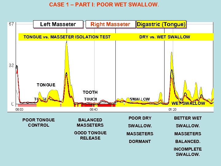 CASE 1 – PART I: POOR WET SWALLOW. Left Masseter Right Masseter TONGUE vs.