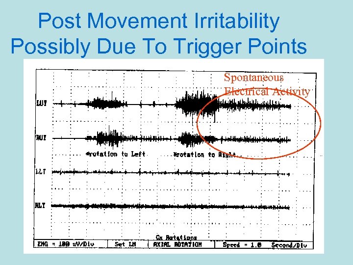 Post Movement Irritability Possibly Due To Trigger Points Spontaneous Electrical Activity 