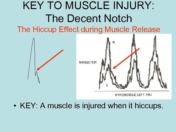 KEY TO MUSCLE INJURY: The Decent Notch The Hiccup Effect during Muscle Release •