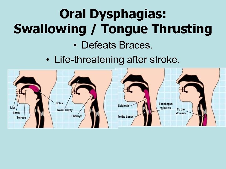 Oral Dysphagias: Swallowing / Tongue Thrusting • Defeats Braces. • Life-threatening after stroke. 