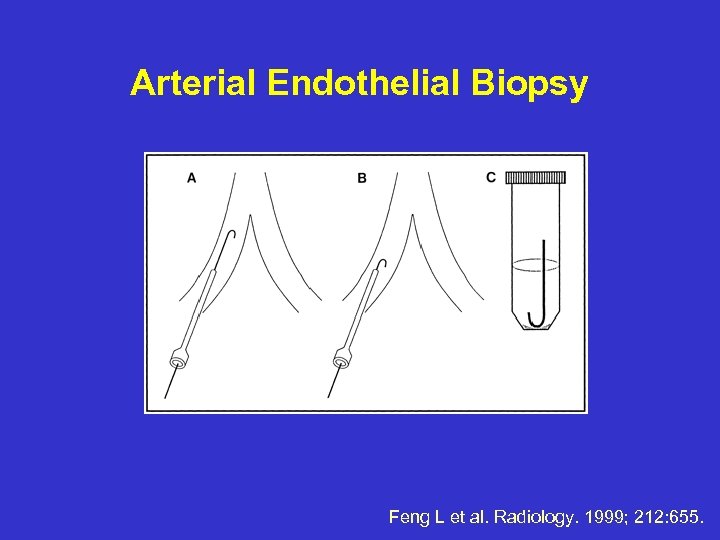 Arterial Endothelial Biopsy Feng L et al. Radiology. 1999; 212: 655. 