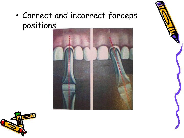  • Correct and incorrect forceps positions 