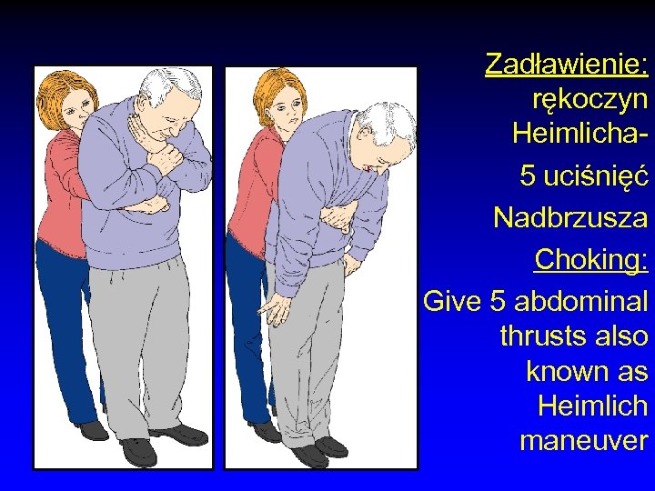 Zadławienie: rękoczyn Heimlicha 5 uciśnięć Nadbrzusza Choking: Give 5 abdominal thrusts also known as