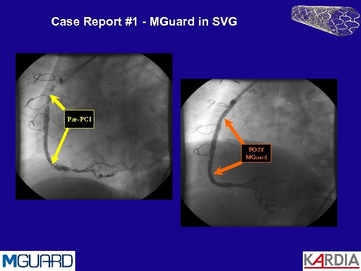 Case Report #1 - MGuard in SVG Pre-PCI POST MGuard 