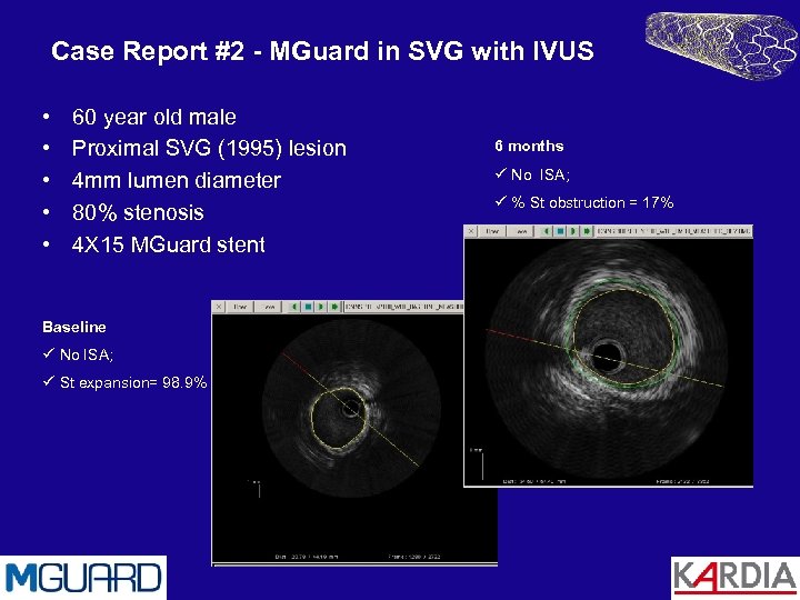 Case Report #2 - MGuard in SVG with IVUS • • • 60 year