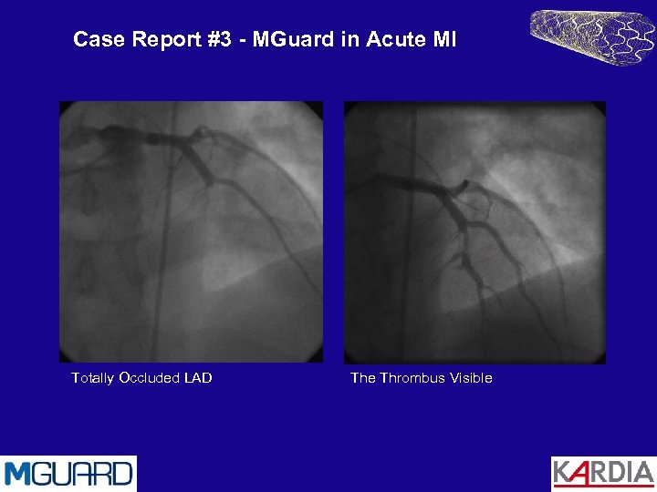 Case Report #3 - MGuard in Acute MI Totally Occluded LAD The Thrombus Visible