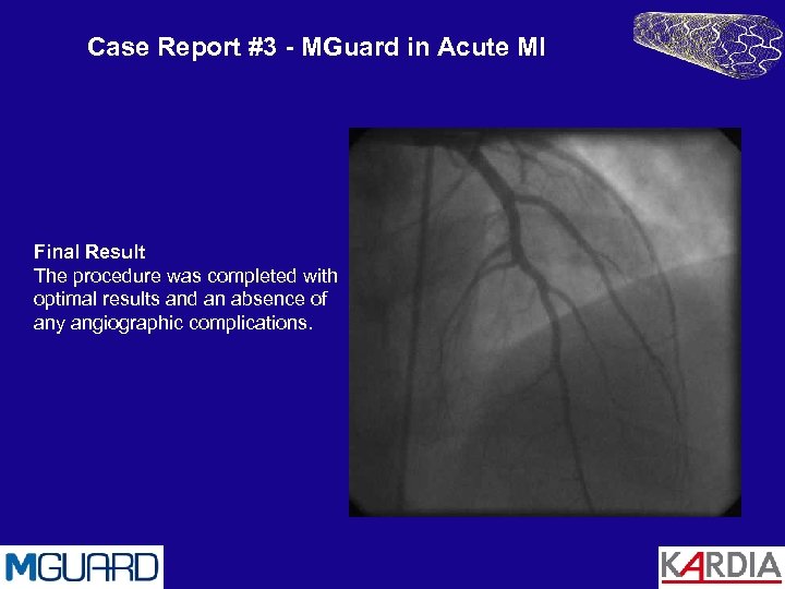 Case Report #3 - MGuard in Acute MI Final Result The procedure was completed