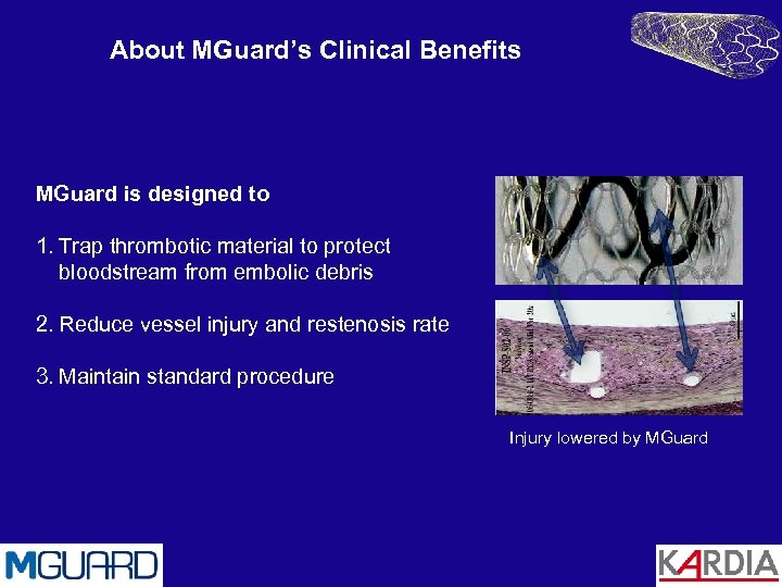 About MGuard’s Clinical Benefits MGuard is designed to 1. Trap thrombotic material to protect