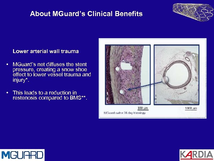 About MGuard’s Clinical Benefits Lower arterial wall trauma • MGuard’s net diffuses the stent