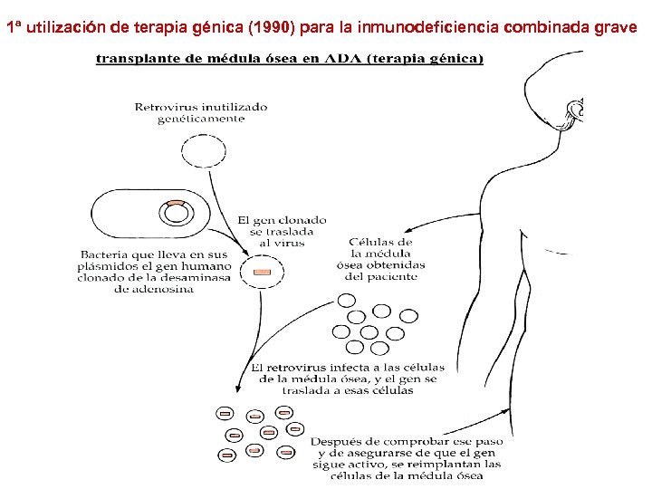 1ª utilización de terapia génica (1990) para la inmunodeficiencia combinada grave 