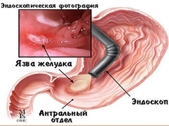 Техника выполнения гастродуаденоскопии 