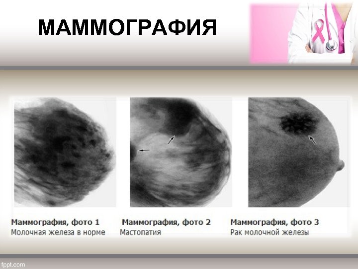  МАММОГРАФИЯ 