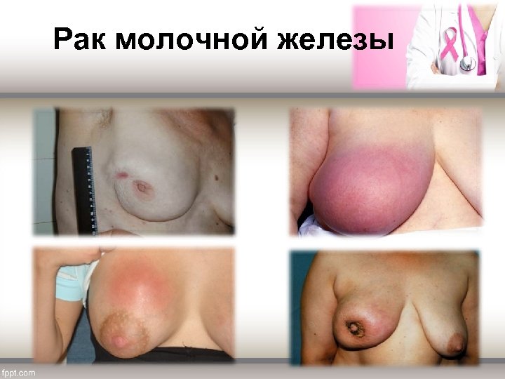  Рак молочной железы 