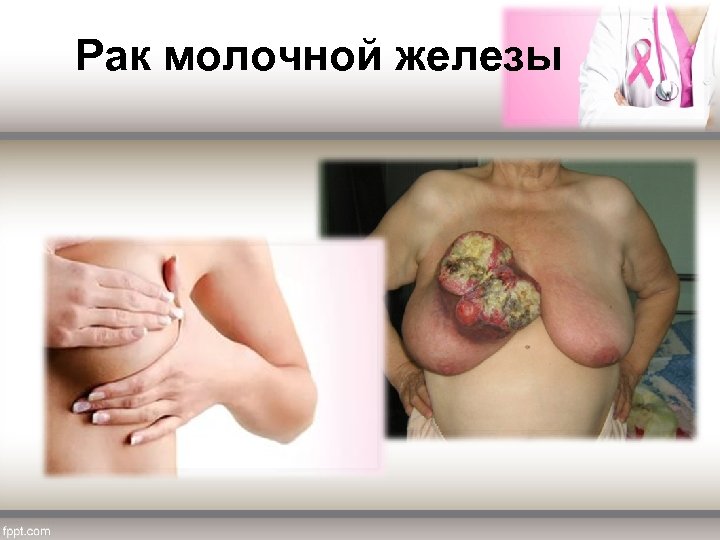  Рак молочной железы 