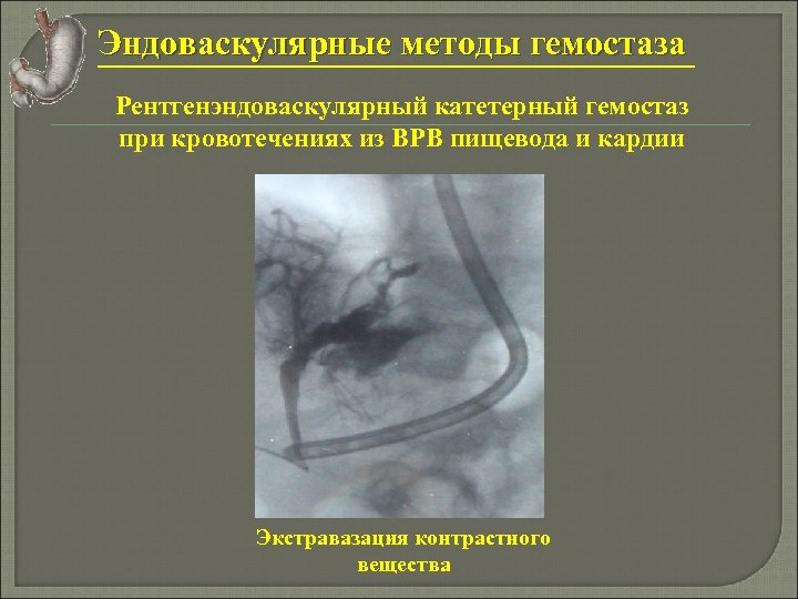 Эндоваскулярные методы гемостаза Рентгенэндоваскулярный катетерный гемостаз при кровотечениях из ВРВ пищевода и кардии Экстравазация