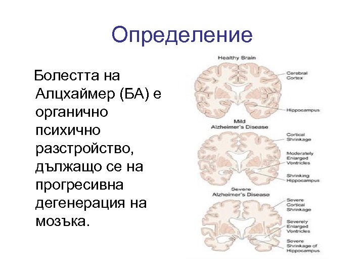 Определение Болестта на Алцхаймер (БА) е органично психично разстройство, дължащо се на прогресивна дегенерация
