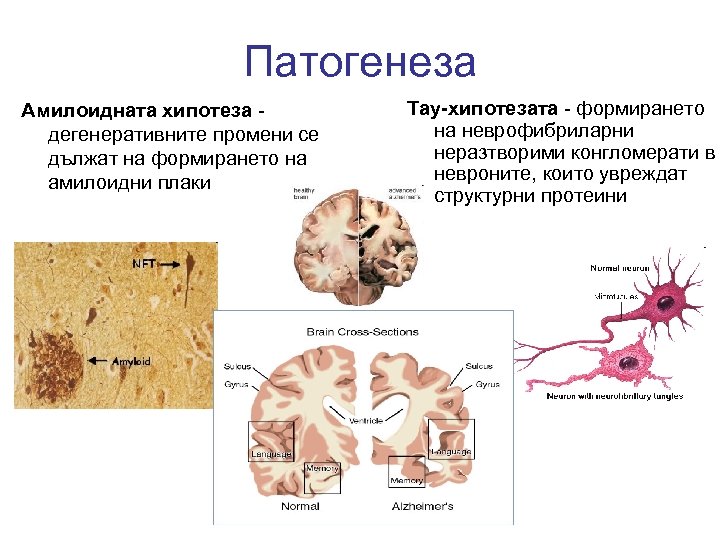 Патогенеза Амилоидната хипотеза дегенеративните промени се дължат на формирането на амилоидни плаки Тау-хипотезата -