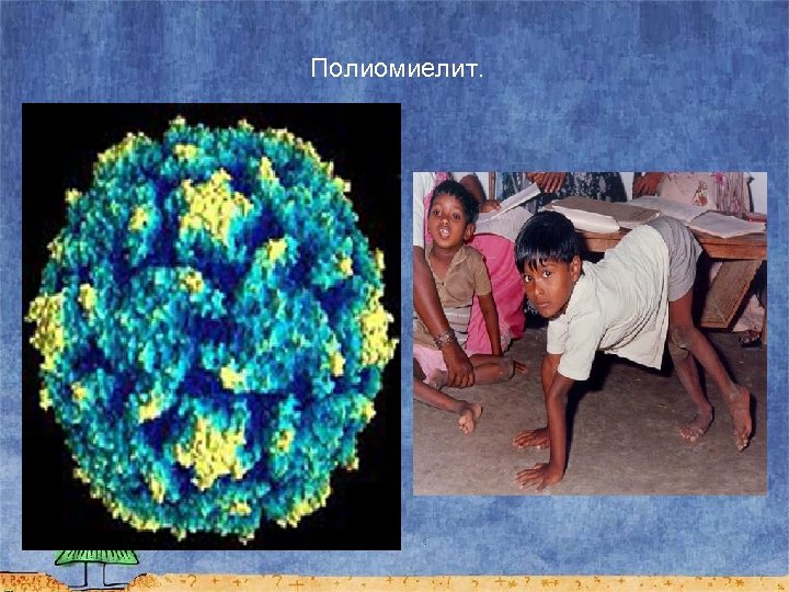 Полиомиелит. 