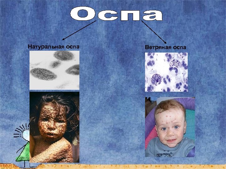 Натура льная о спа Ветряная оспа 