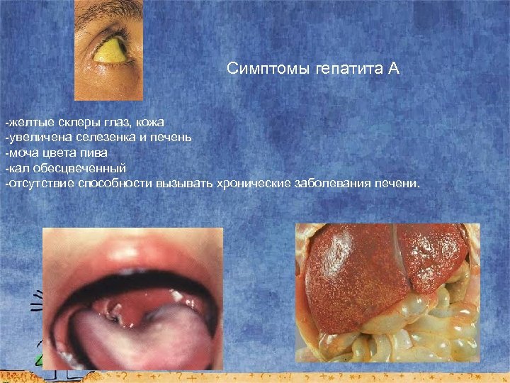 Симптомы гепатита А -желтые склеры глаз, кожа -увеличена селезенка и печень -моча цвета пива