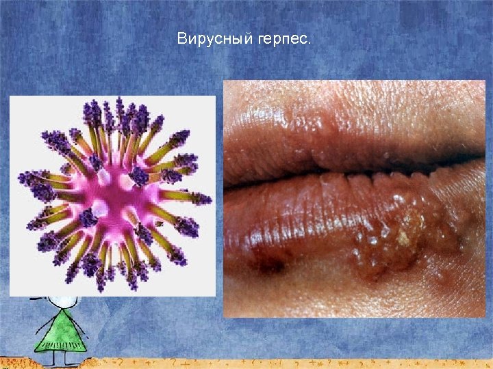 Вирусный герпес. 