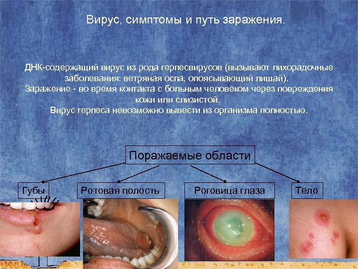 Вирус, симптомы и путь заражения. ДНК-содержащий вирус из рода герпесвирусов (вызывают лихорадочные заболевания: ветряная