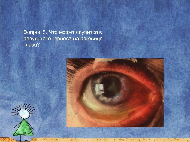 Вопрос 5. Что может случится в результате герпеса на роговице глаза? 